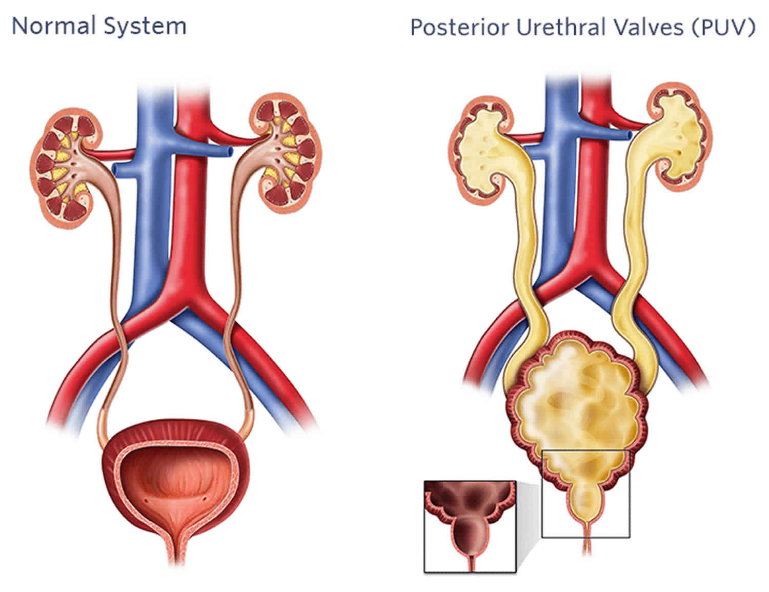 Extreme urethral fan images