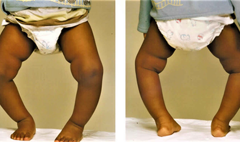 Blount’s disease