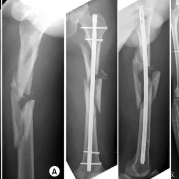 Comminuted fracture
