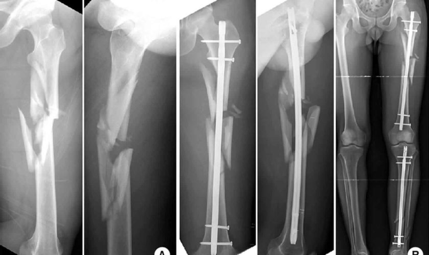 Comminuted fracture