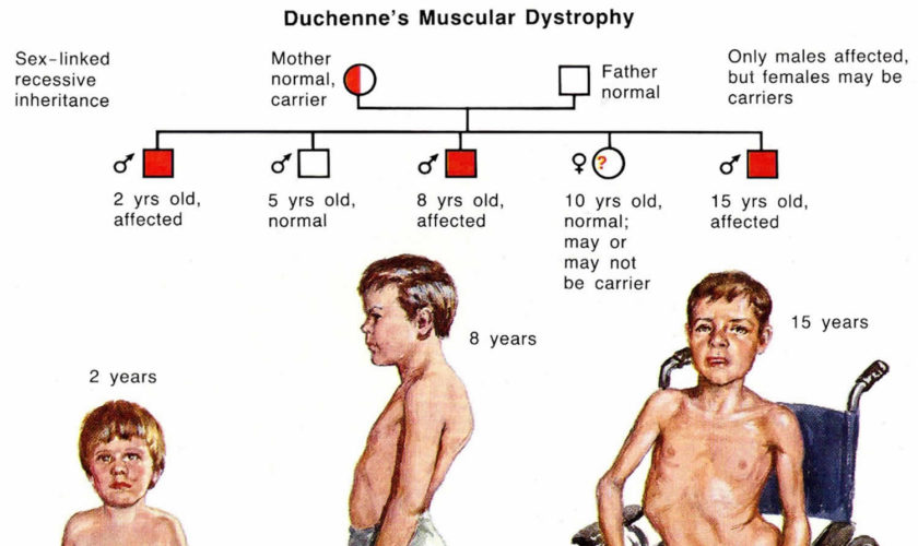 Duchenne muscular dystrophy