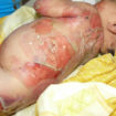 Epidermolysis bullosa