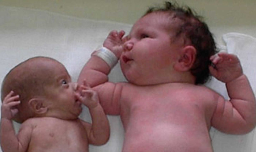 Intrauterine growth restriction