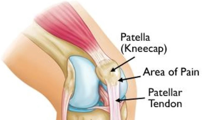 Jumper’s knee