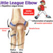 Little league elbow