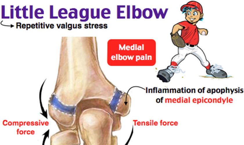 Little league elbow