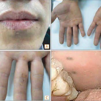 Peutz-Jeghers-syndrome