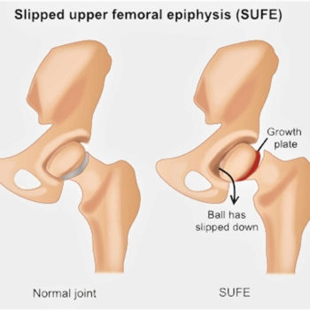 Slipped capital femoral epiphysis