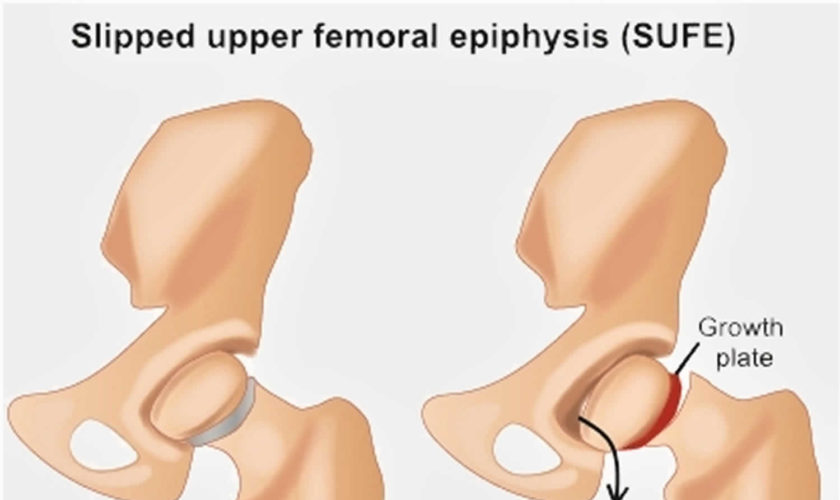 Slipped capital femoral epiphysis