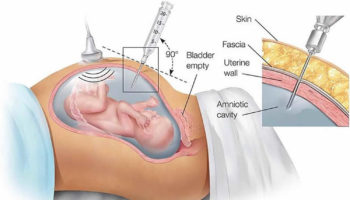 amniocentesis