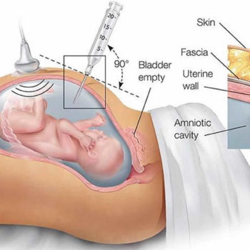 amniocentesis