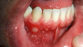 aphthous stomatitis