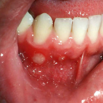 aphthous stomatitis