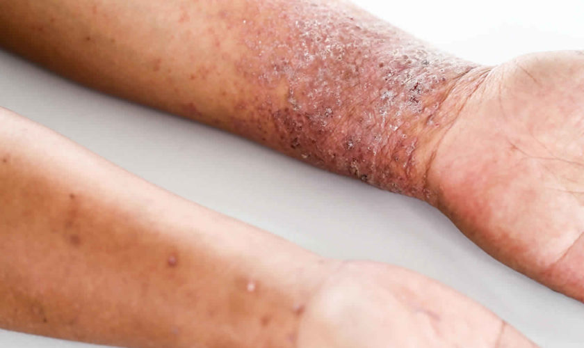 atopic dermatitis