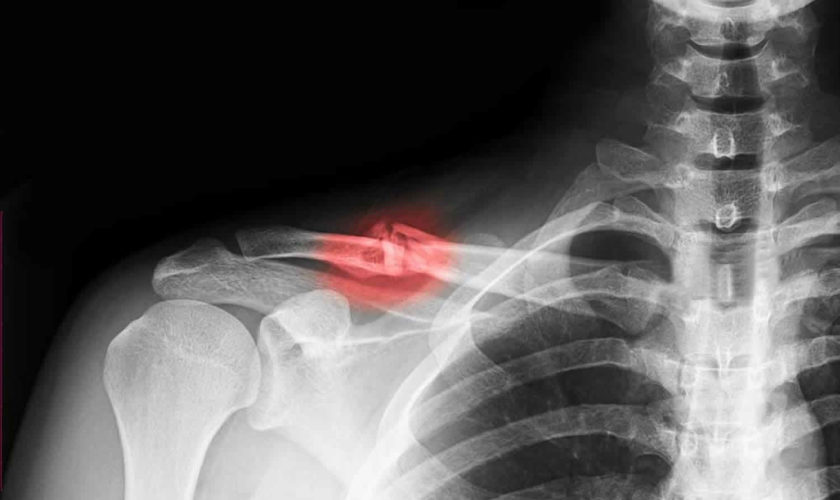 broken collarbone