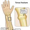 buckle fracture