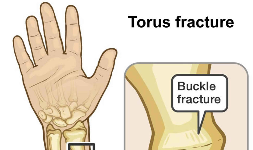 buckle fracture