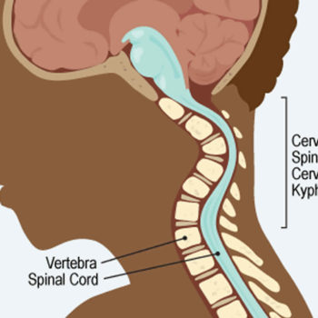 cervical kyphosis