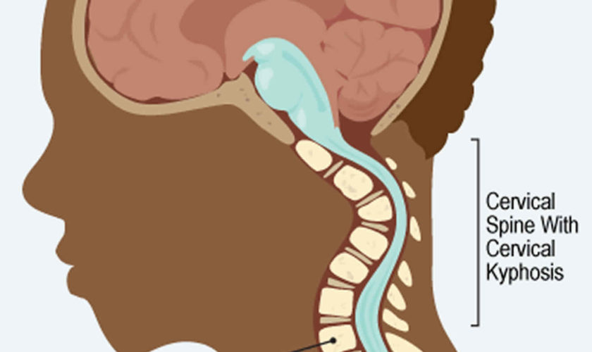 cervical kyphosis