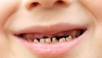 child-rotten-teeth