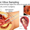 Chorionic villus sampling