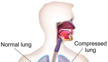 chylothorax