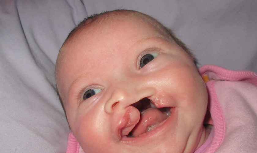cleft-lip-and-cleft-palate