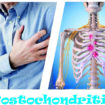 costochondritis