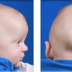 craniosynostosis