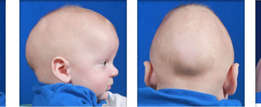 craniosynostosis