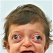 crouzon syndrome