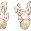 developmental dysplasia of the hip