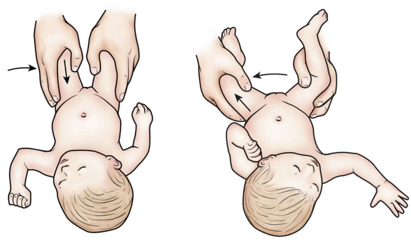 developmental dysplasia of the hip