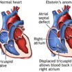 ebstein-anomaly