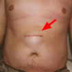 epigastric hernias