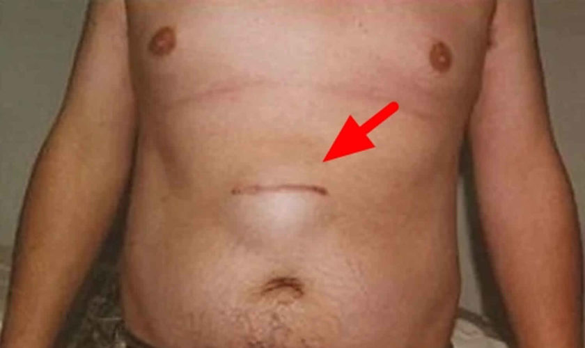 epigastric hernias