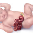 gastroschisis