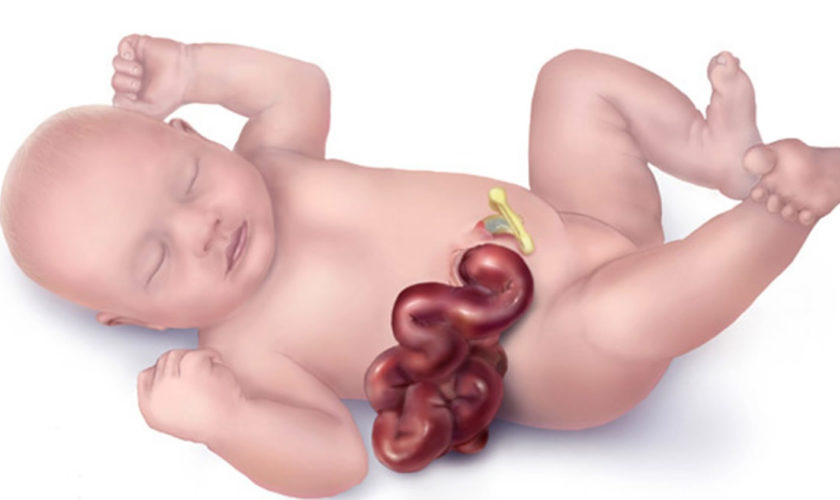 gastroschisis