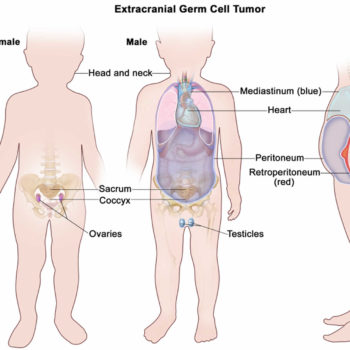 germ cell tumors