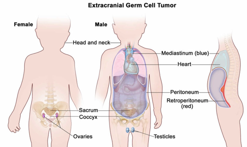 germ cell tumors