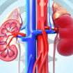 glomerulonephritis