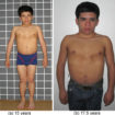 growth hormone deficiency