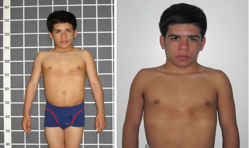 growth hormone deficiency