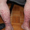 idiopathic thrombocytopenic purpura