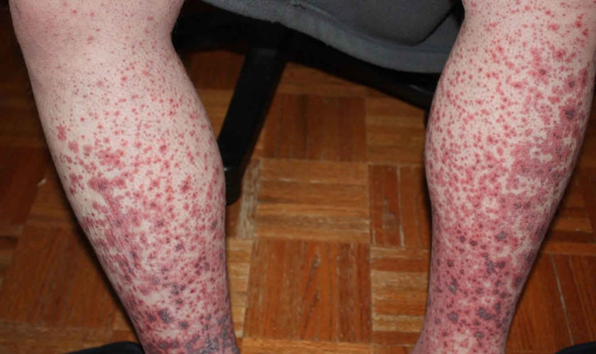 idiopathic thrombocytopenic purpura