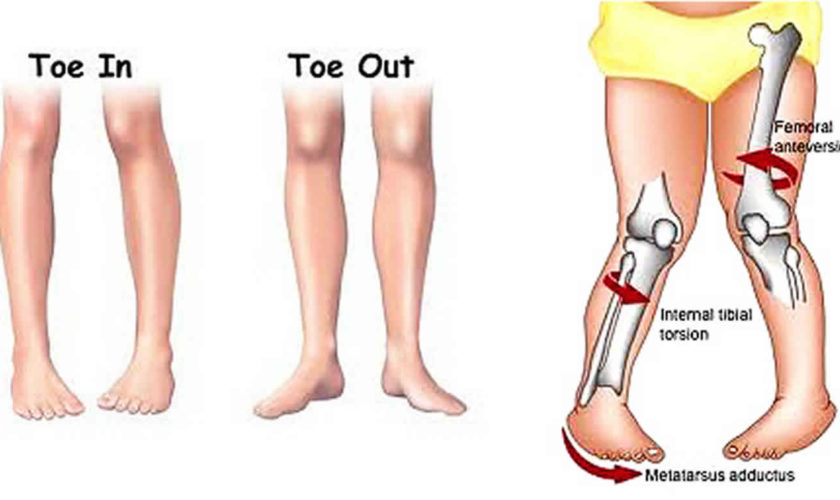 in toe walking