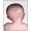 infant torticollis