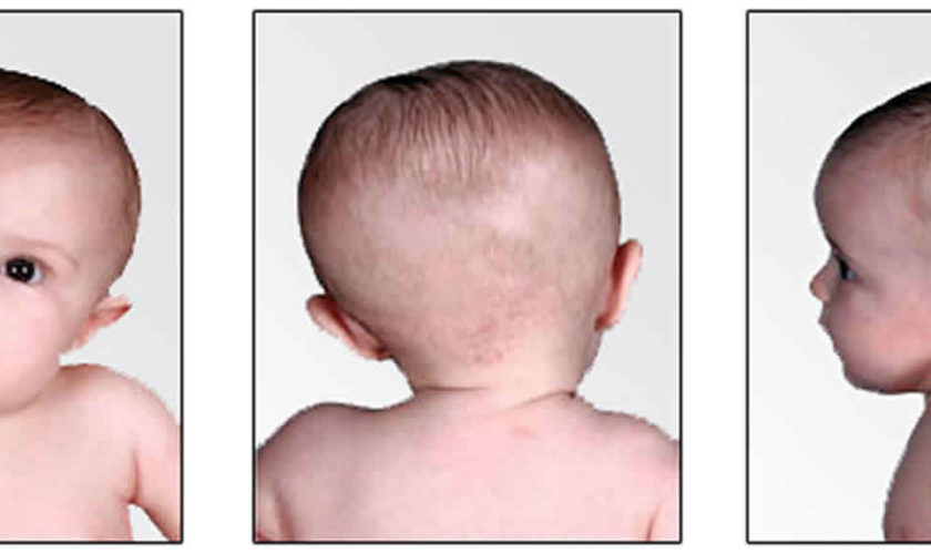 infant torticollis