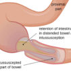 intussusception