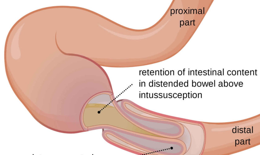 intussusception